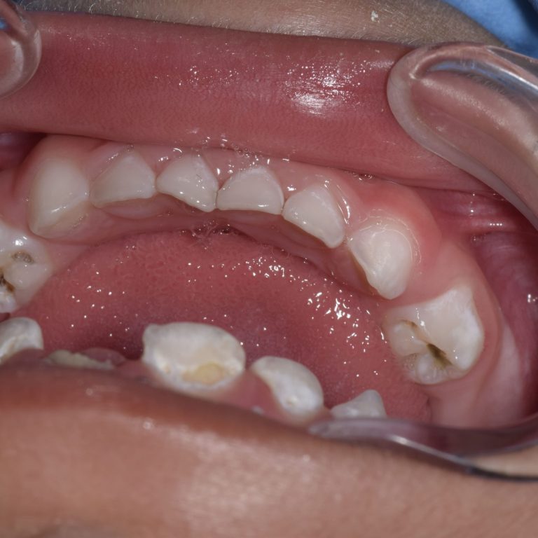 Caries de la primera infancia