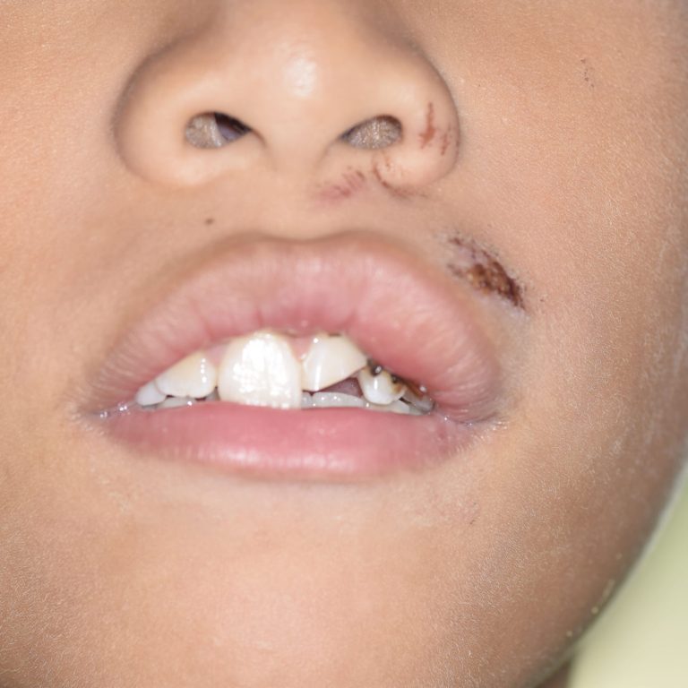 Traumatismo dental en niños